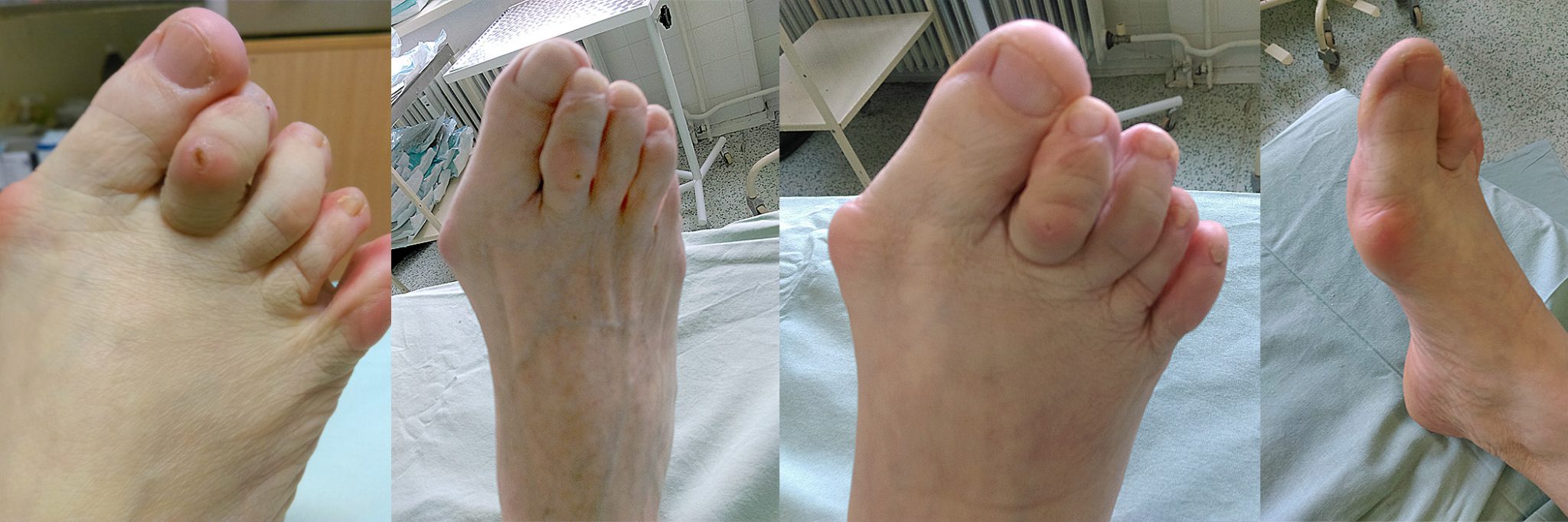 hallux-vagus1