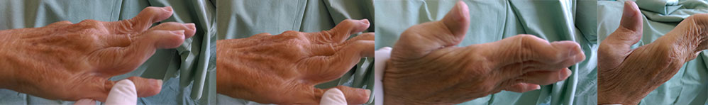 arthrolyza-arthrodeza